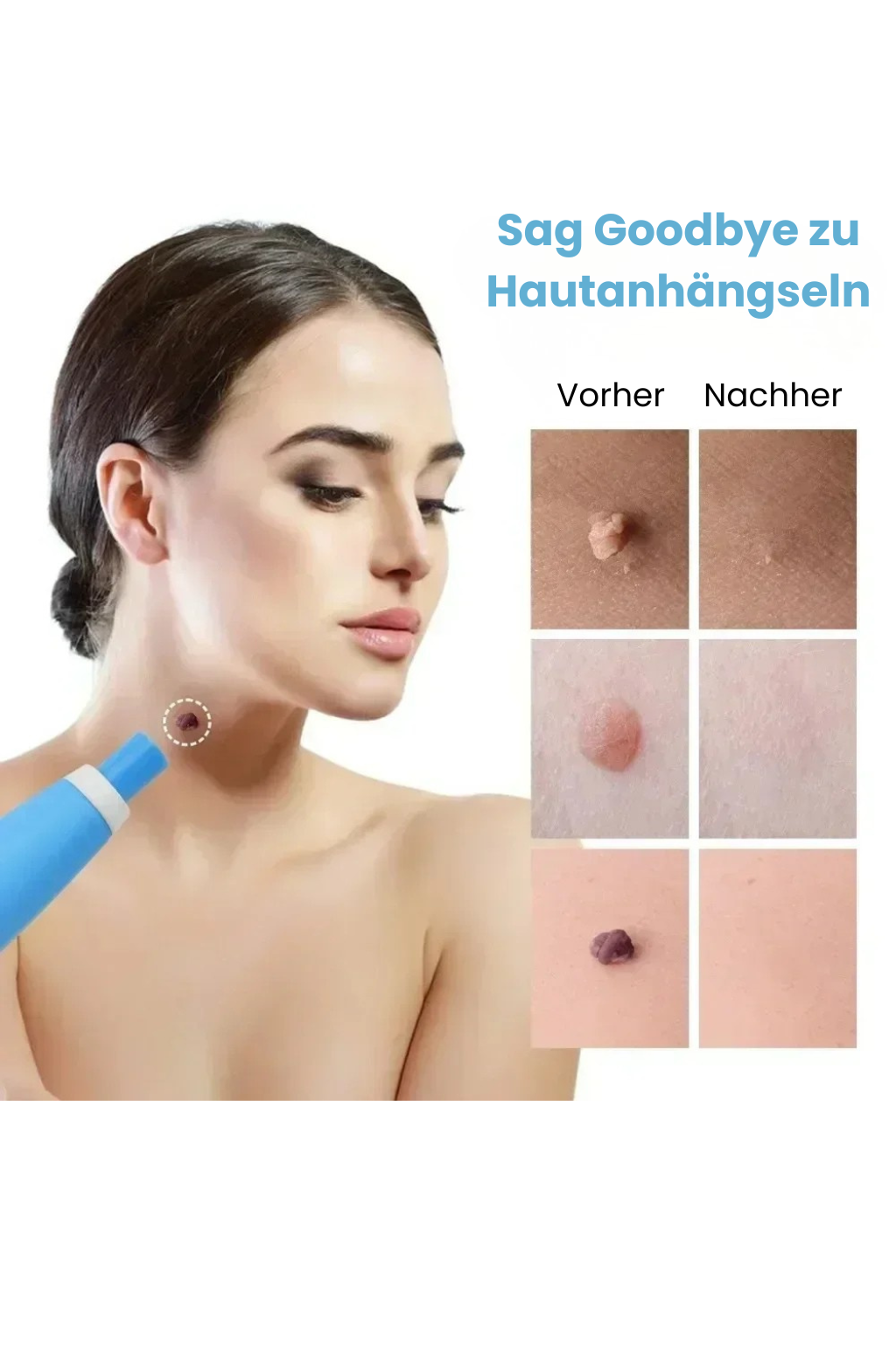 LumiSkin Care Pen | Hautanhängsel mühelos entfernen